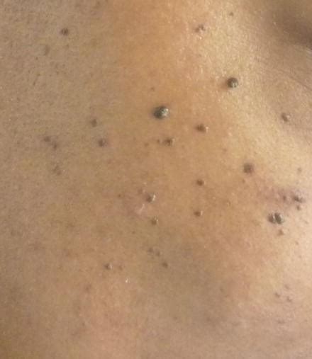 Dermatosis Papulosa Nigra Springerlink