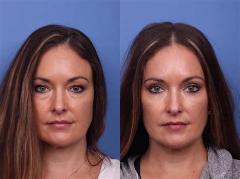 Blepharoplasty Before And After Photo Gallery Scottsdale Az Hobgood Facial Plastic Surgery