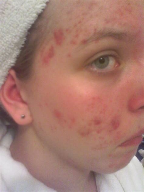 Do I Have Severe Acne Photos General Acne Discussion Forum