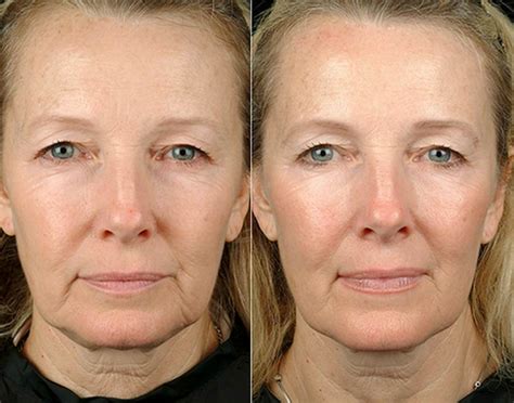 Thermage Flx For Face And Body Thermage Skin Tightening Bellevue Thermage