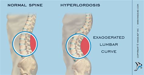 Hiperlordosis Lumbar
