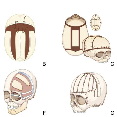 Early Surgical Methods For The Craniosynostosis A A Simple Linear