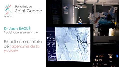 L embolisation artérielle de la prostate une technique mini invasive