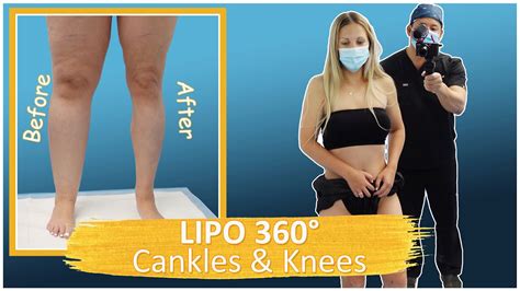 Liposuction Results Cankles And Knees Lipo 360° Legs Lipedema Surgery Expert Dr Thomas Su