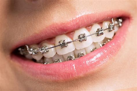 Invisible Braces Dentist Bury St Edmunds Mildenhall Suffolk And
