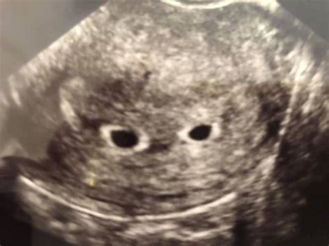 Identical Twins Ultrasound 5 Weeks
