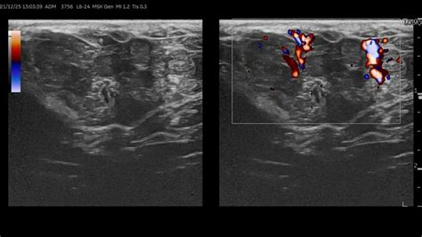 Echo Image Of The Subcutaneous Perianal Gland Adenoma In A Dog Using