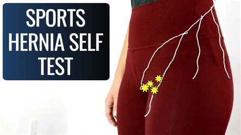 Sports Hernia Self Test Try It Youtube