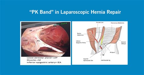 Hernia Repair Surgery India Hernia Repair India Safe Hernia Repair Vrogue