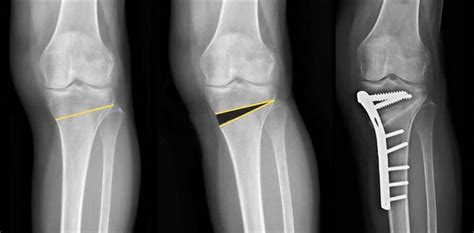 Knee Preservation Osteotomy Surgery Mumbai Dr Jay Shah