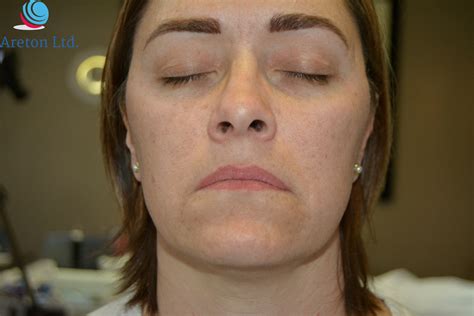 Eyelids Tightening Forehead Plasma Treatment Voltaicplasma Areton Ltd
