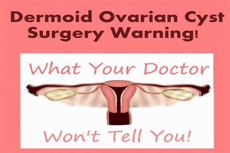 Dermoid Ovarian Cyst Surgery Warning