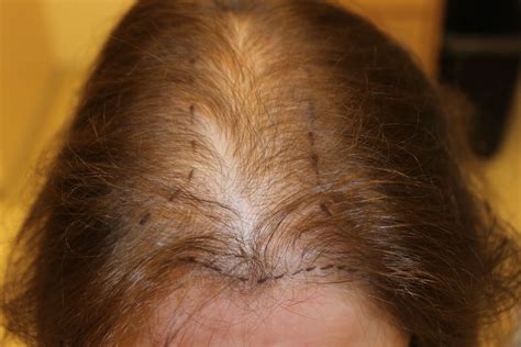 The Different Causes Of Hair Loss Telogen Effluvium Justinboey