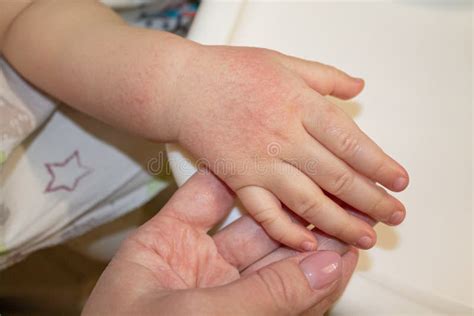Rode Vlekken Op De Huid Van De Handen Van Een Kind Allergie Voor