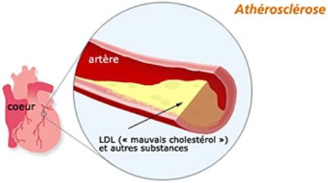 Le cholestérol Conseils Alimentation saine Perte de poids
