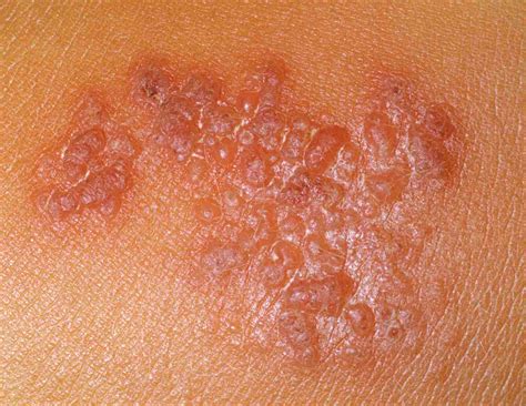 Itchy Bumps Filled With Clear Liquid Causes And Treatment