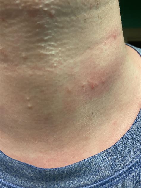 Skin Concerns Itchy Skin Colored Pimple Looking Things On Neck That