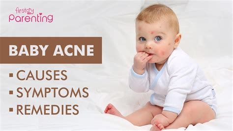 Baby Acne Causes Symptoms And Treatment Youtube