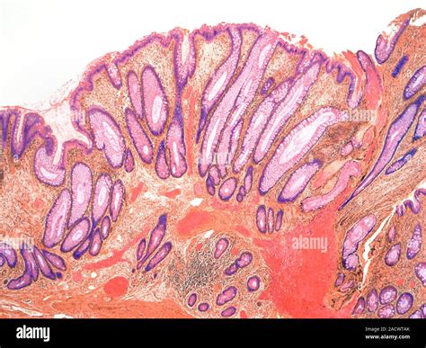 Colorectal Polyp Light Micrograph Of A Section Through A Colorectal
