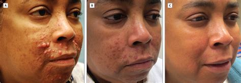 Cutaneous Rosai Dorfman Disease Successfully Treated With Low Dose