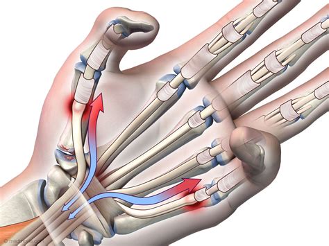 Related online courses on physioplus. Medmovie.com | Tendon Rupture Following Trigger Finger Release