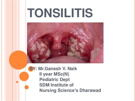 Tonsilitis Ppt 1