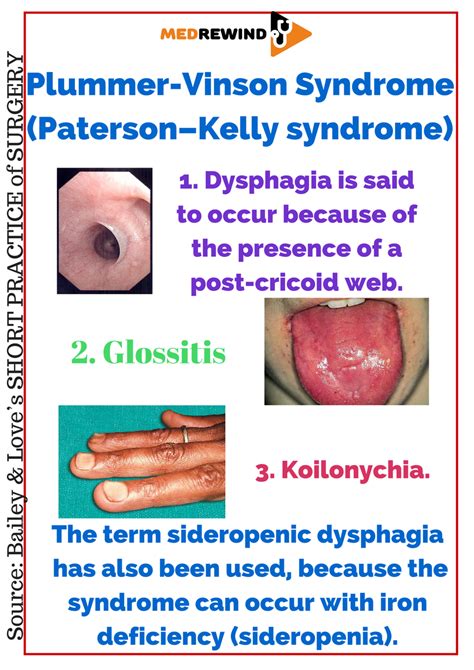 Sideropenic Dysphagia