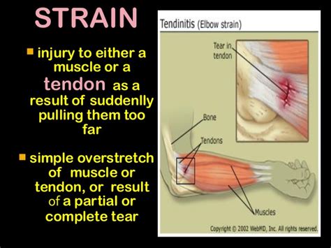 Sprain Vs Strain Whats The Difference Zeusonmedicines Pvt Ltd