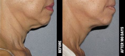 Best Non Surgical Neck Lift With Ultherapy Nusculpt