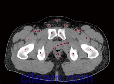Functional anatomy of the male pelvic floor online course: Learn CT Scan: Anatomy CT Axial Abdomen and Pelvis Male