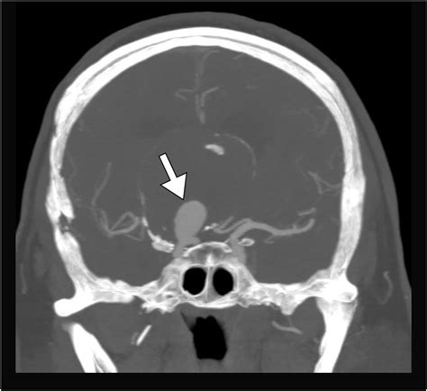Cureus Giant Unruptured Internal Carotid Artery Aneurysm