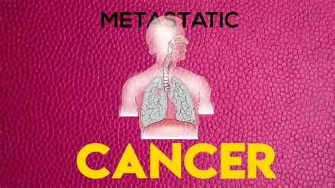 Metastatic Cancer Definition Causes And How It Develps 2023