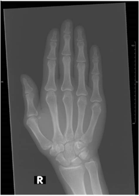 X Ray Of The Right Hand Showing Only Soft Tissue Swelling In The