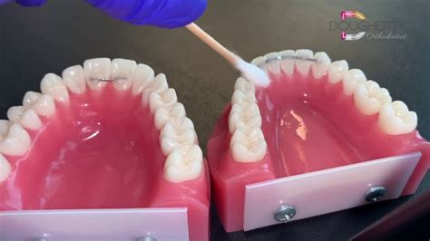 What To Do About A Loose Permanent Retainer Dougherty Orthodontics