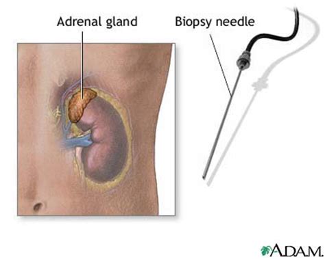 Adrenal Gland Biopsy MedlinePlus Medical Encyclopedia Image