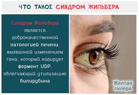 Синдром жильбера диета питание меню Синдром Жильбера – симптомы, рекомендуемая диета и средства от болезни Синдром Жильбера – симптомы, рекомендуемая диета и средства от болезни Синдром жильбера диета питание меню