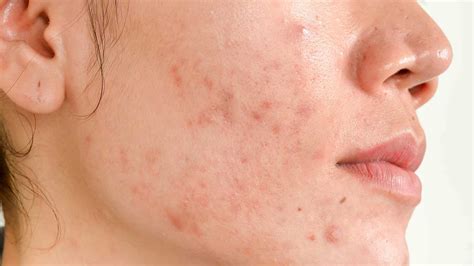 Easy Ways To Prevent Acne Scars On The Face Pharmacy In City