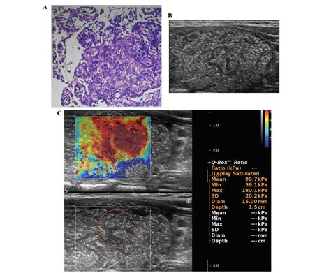 Shear Wave Elastography Diagnosis Of The Diffuse Sclerosing Variant Of