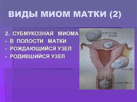 МИОМА МАТКИ Миома матки доброкачественная опухоль развивающаяся Картинка - МИОМА МАТКИ Миома матки доброкачественная опухоль развивающаяся