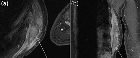 The coronal plane is often the most useful for evaluating bony anomalies, spondylolysis, or degeneration of they are usually acquired on both axial and coronal planes to image the small and large bowel, with • consider mri of the cervical spine if patient has signs or symptoms of myelopathy. Magnetic resonance imaging scan of (a) transverse plane ...