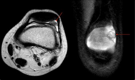 Axial T2 And Coronal Pd Fat Sat Mri Scans Of The Left Knee Showing The