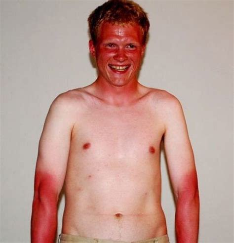Darwins Exceptions 38 Photos Funny Sunburn Ginger Jokes Bad Sunburn