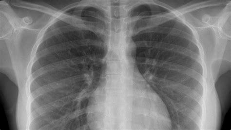 En explorant les poumons avec une sonde, le médecin permet à un ordinateur de reconstituer les bronches du patient en trois dimensions. Radiographie pulmonaire : définition, déroulement de l ...
