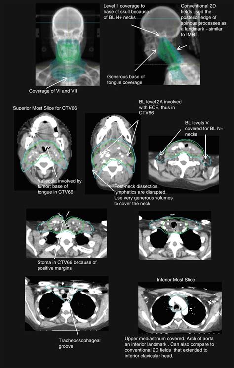 Laryngeal Carcinoma Radiology Key