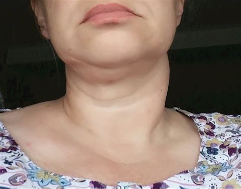 Swollen Neck And Thyroid Nodule But Blood Thyroid Uk