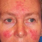 Images of Home Remedies For Rosacea Papules