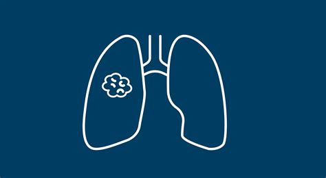 Experts Make The Case For More Inclusive Lung Cancer Screening Guidelines Vnchidoka
