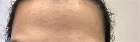 Skin Concern Does Anyone Know How To Get Rid Of Bumps On Forehead