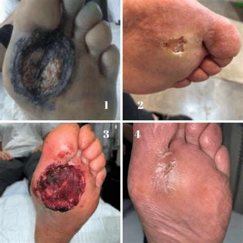 Skin Cancer On Your Feet