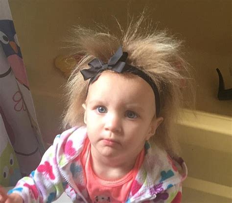 Two Year Old Has Uncombable Hair Syndrome Daily Mail Online